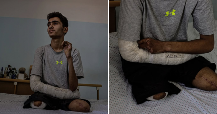 Young Gaza Gymnast Dreams Of Recovery After Losing Legs In Israeli Attack